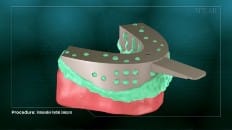 Removable Partial Dentures 003