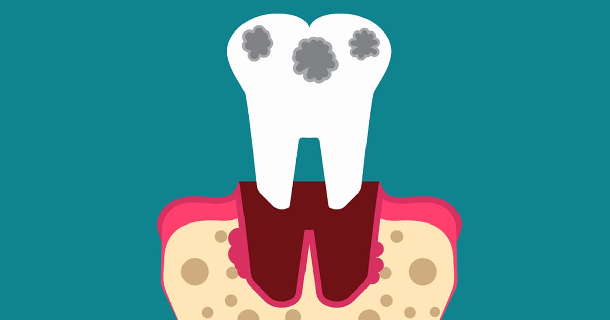 Learn your Risk for Gum Disease from Affordable Dental Care Experts