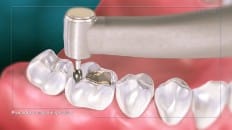Amalgam Filling (Posterior) 006