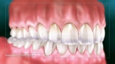 Composite Filling (Anterior) 007