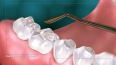 Composite Filling (Posterior) 003