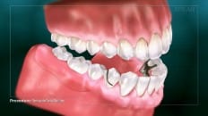 Removable Partial Dentures 006
