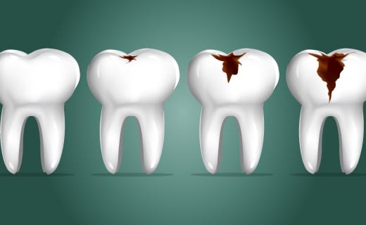 Your Eating Disorder and Teeth - What You Need to Know