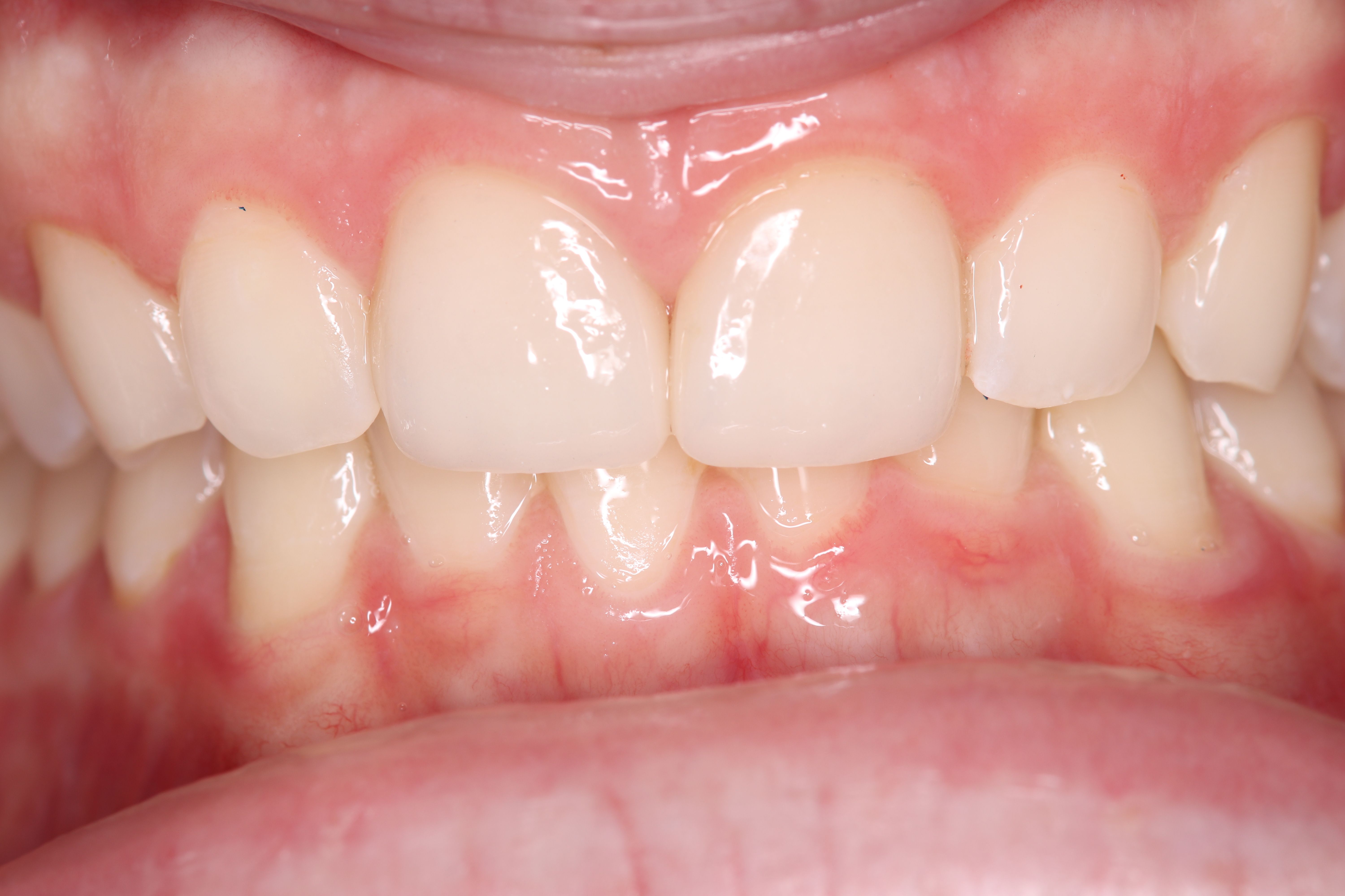 Rasner Smile gallery after 1