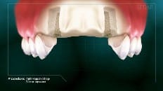 Implant-Supported Bridge 004