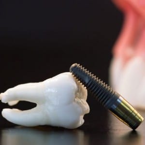 Dental implant
