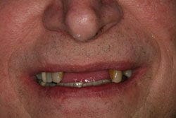 Same Day Permanent Dentures before