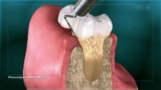Gingival Probing And Pocket Depth 005