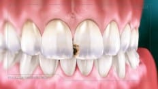 Composite Filling (Anterior) 001