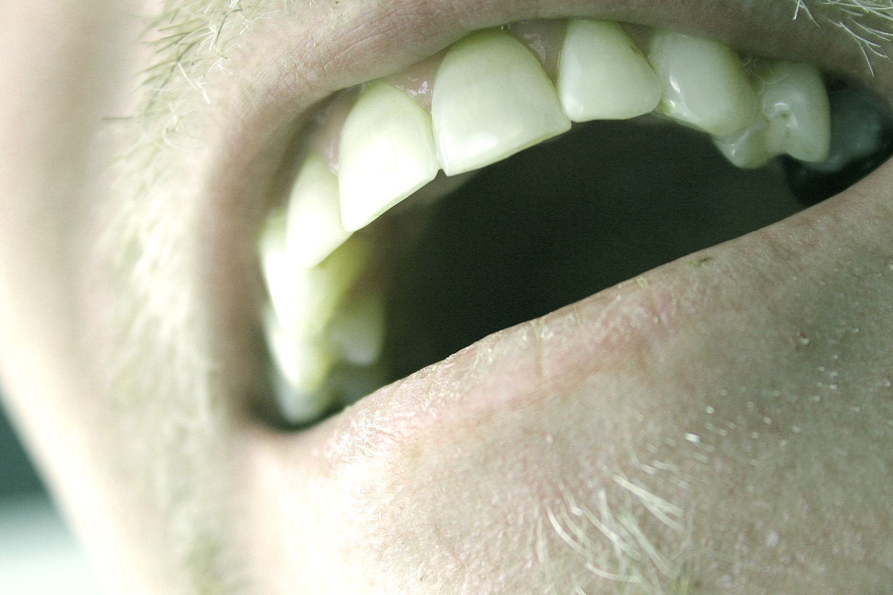 Top Candidates for Full Mouth Reconstruction Top Candidates for Full Mouth Reconstruction