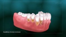 Non-Carious Cervical Lesions 006