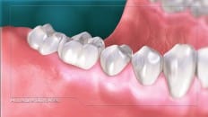 Gingival Probing And Pocket Depth 001