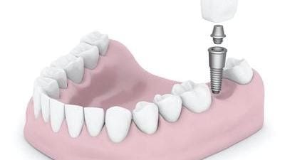 DEntal Implants DEntal Implants