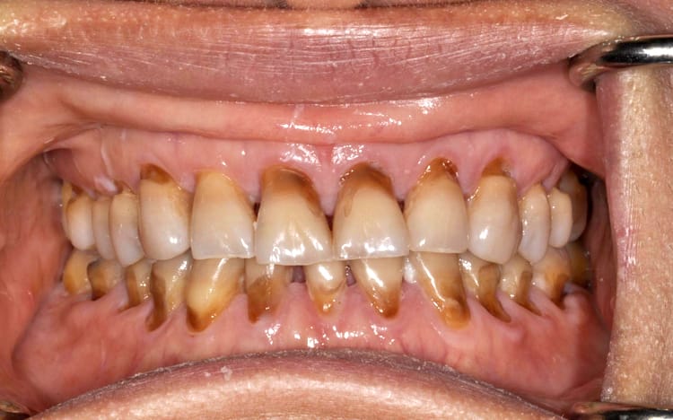 23 (1). Patient LL (14 teeth)_ 6 porcelain crowns on upper front teeth and 11 porcelain crowns on lower teeth Before