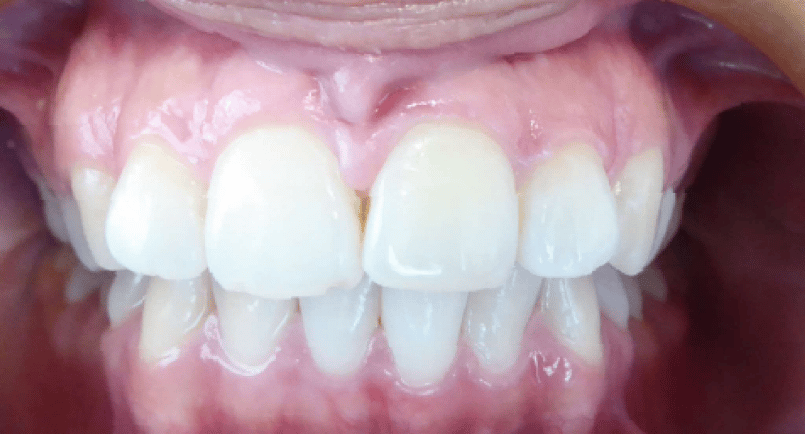 Front Grin for Virtual Orthodontic Consultation