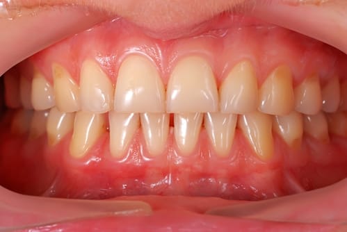 Did prehistoric humans have better teeth than us? Did prehistoric humans have better teeth than us?