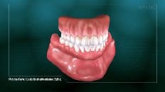 Locator Retained Overdenture (Reline) 009
