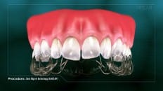 Clear Aligner Technology (Impression) 004