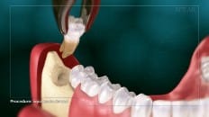 Surgical Extraction (3rd Molar) 003