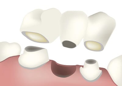 Treating Gum Disease Around a Bridge
