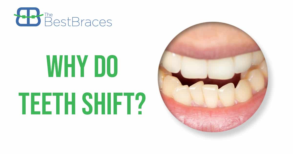 Why Do Teeth Shift? Why Do Teeth Shift?