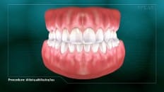 Whitening With Bleaching Tray 006