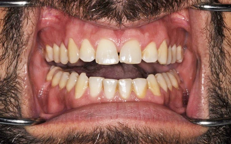5 (1). Patient KT_ One front tooth porcelain veneer and an adjacent implant with custom tissue shaping and porcelain implant crown Before