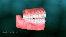 Anterior Open Bite 002