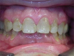 Veneers before