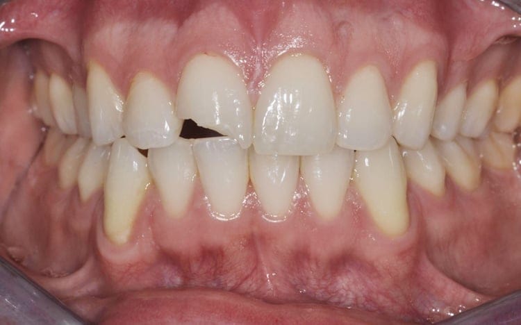 2 (1). Patient JP (1 tooth)_ Single front tooth porcelain crown Before