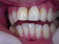 Veneers before