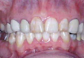 ballston smile gallery case-11-before