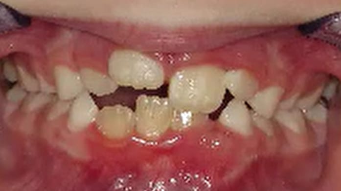 BF Ortho Smile Gallery Before