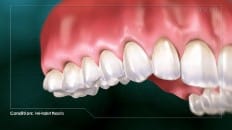 Peri-Implant Mucositis 005