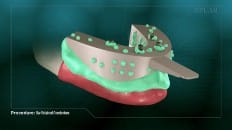 Bar Retained Overdenture 007