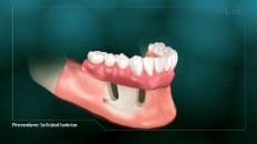 Bar Retained Overdenture 004