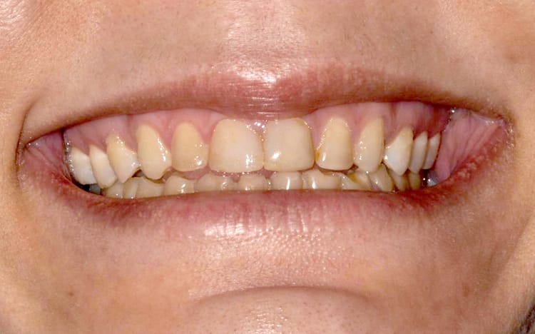 27. Patient MR (all 28 teeth)_ 14 upper porcelain crowns and 14 lower porcelain crowns Before