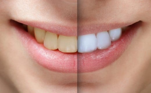 Are You a Good Candidate for Professional Teeth Whitening? Are You a Good Candidate for Professional Teeth Whitening?