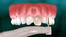 Veneers (Impression) 003
