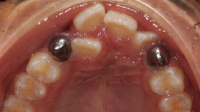 BF Ortho Smile Gallery Before