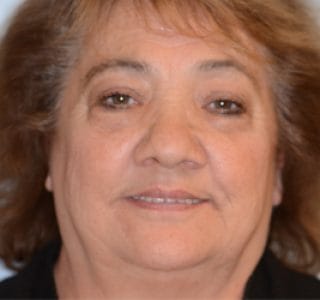 Dental Implants Before