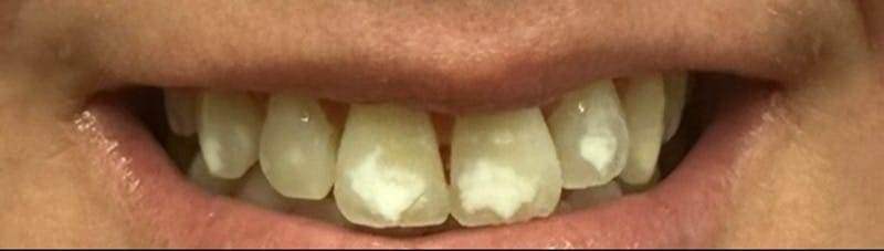 Bright Smiles Marble Falls Case 4 before
