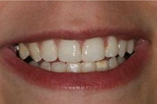 Bonding & Whitening after