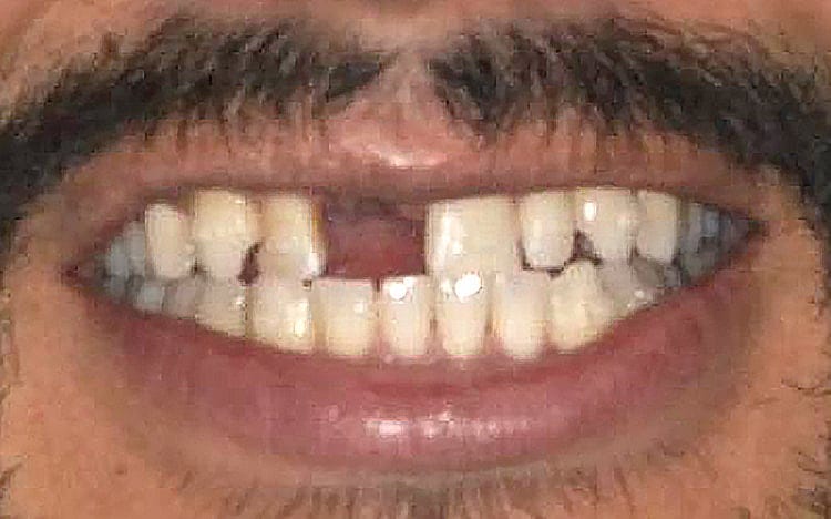 8. Patient J.D_ 2 porcelain crowns for smaller peg lateral teeth, implant front tooth with custom tissue shaping and porcelain implant crown, and front tooth porcelain veneer Before