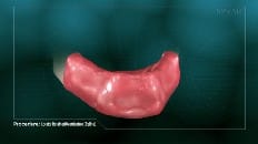 Locator Retained Overdenture (Reline) 001