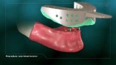 Locator Retained Overdenture 009