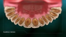 Dental Erosion 003