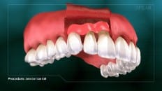 Connective Tissue Graft 002
