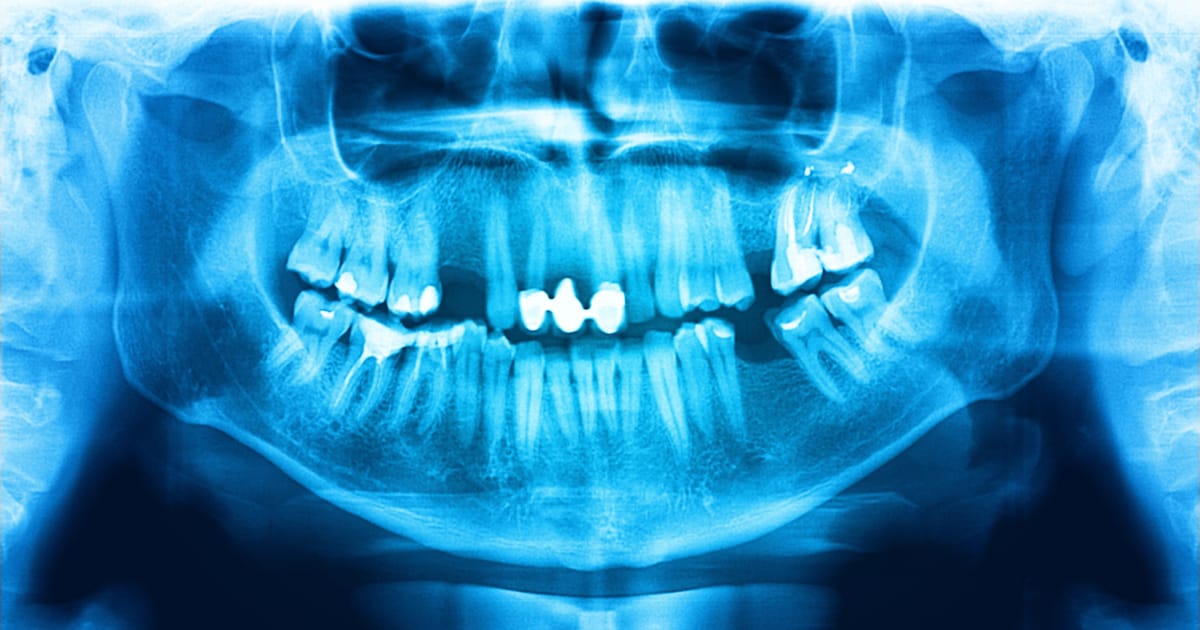 Are Dental X-Rays Really Safe?