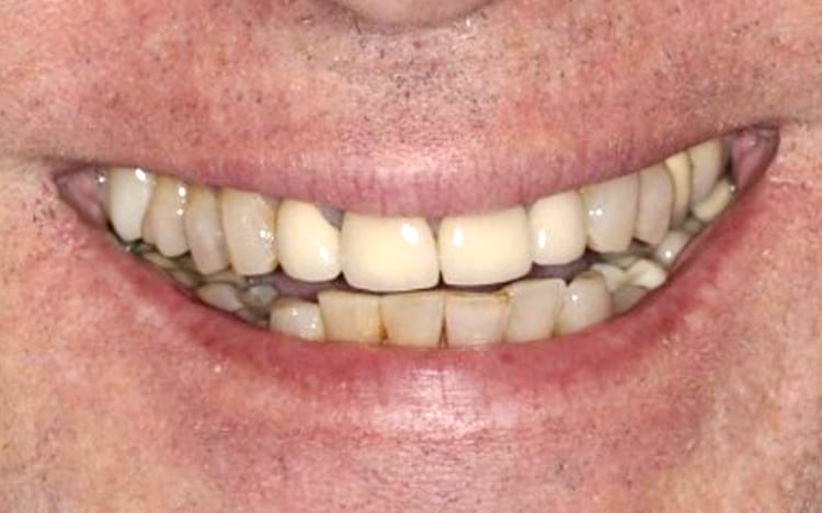 21. Patient KN (14 teeth)_ Porcelain crowns on upper 14 teeth Before